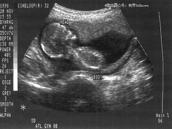 胎儿超声的历史 | 妊娠成像 | 现场科学