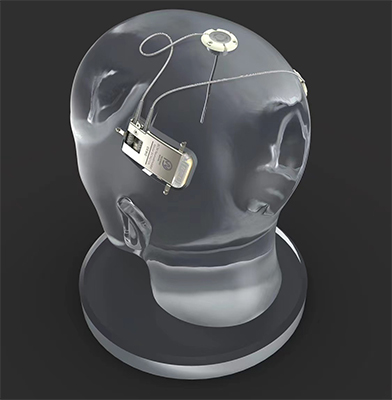 植入式闭环自响应神经刺激系统