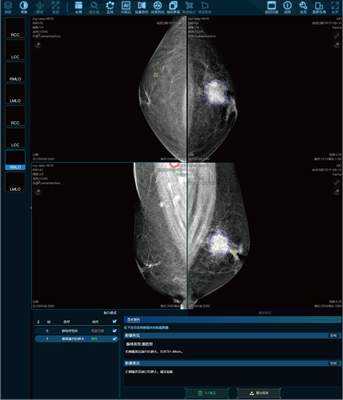 医准智能乳腺钼靶智能检测系统（其中之一） LOGO